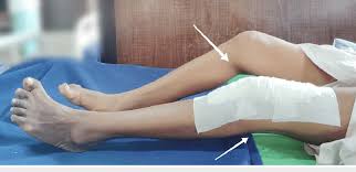 Knee Pain